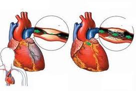 Phù phổi cấp do tim