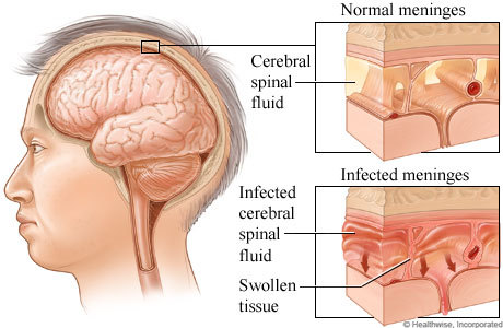 Viêm màng não (Meningitis)