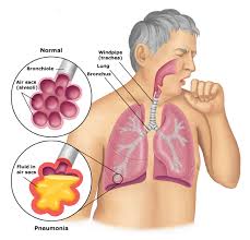 Viêm phổi ( Pneumonia)