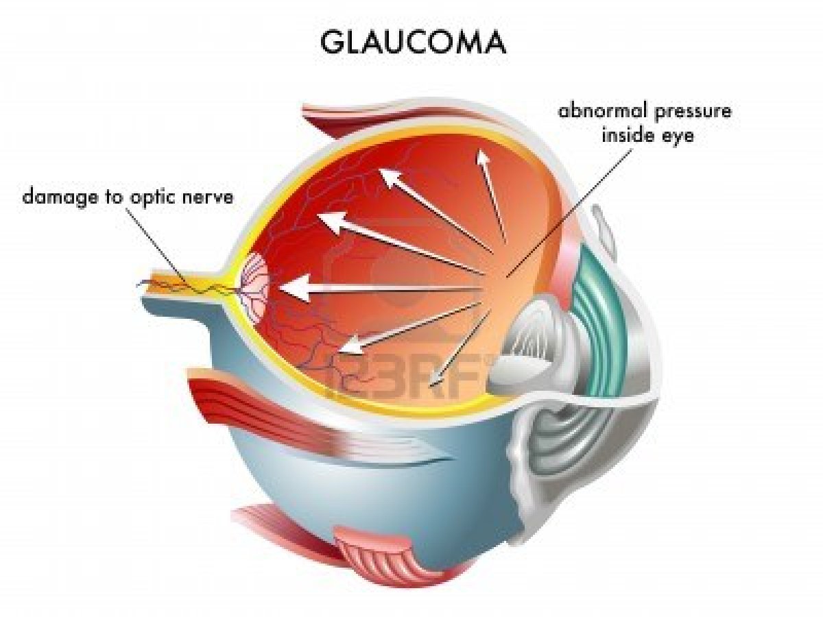 Phác đồ điều trị bệnh Glaucome