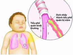 Chẩn đoán và điều trị Viêm phổi ở trẻ em