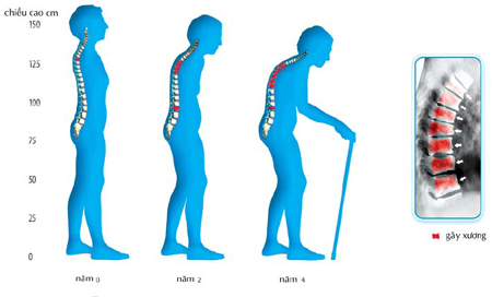 Hiểu biết về bệnh loãng xương