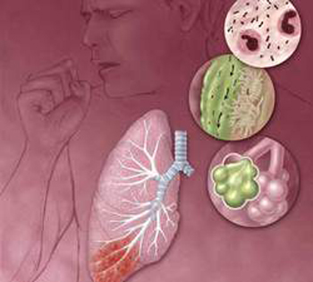 Tràn dịch màng phổi không chỉ đơn thuần bệnh lao