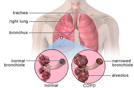 Quản lý Bệnh phổi tắc nghẽn mãn tính và hen phế quản