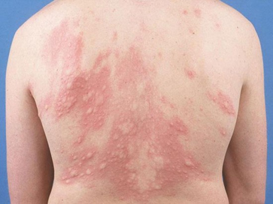 Các bệnh về da thường gặp khi mùa đông về