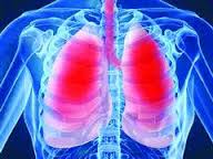 Corticoid làm giảm tỷ lệ tử vong do viêm phổi có đáp ứng viêm mạnh ?
